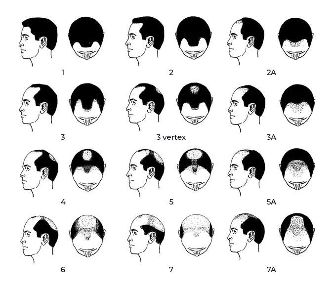 The Norwood Scale
